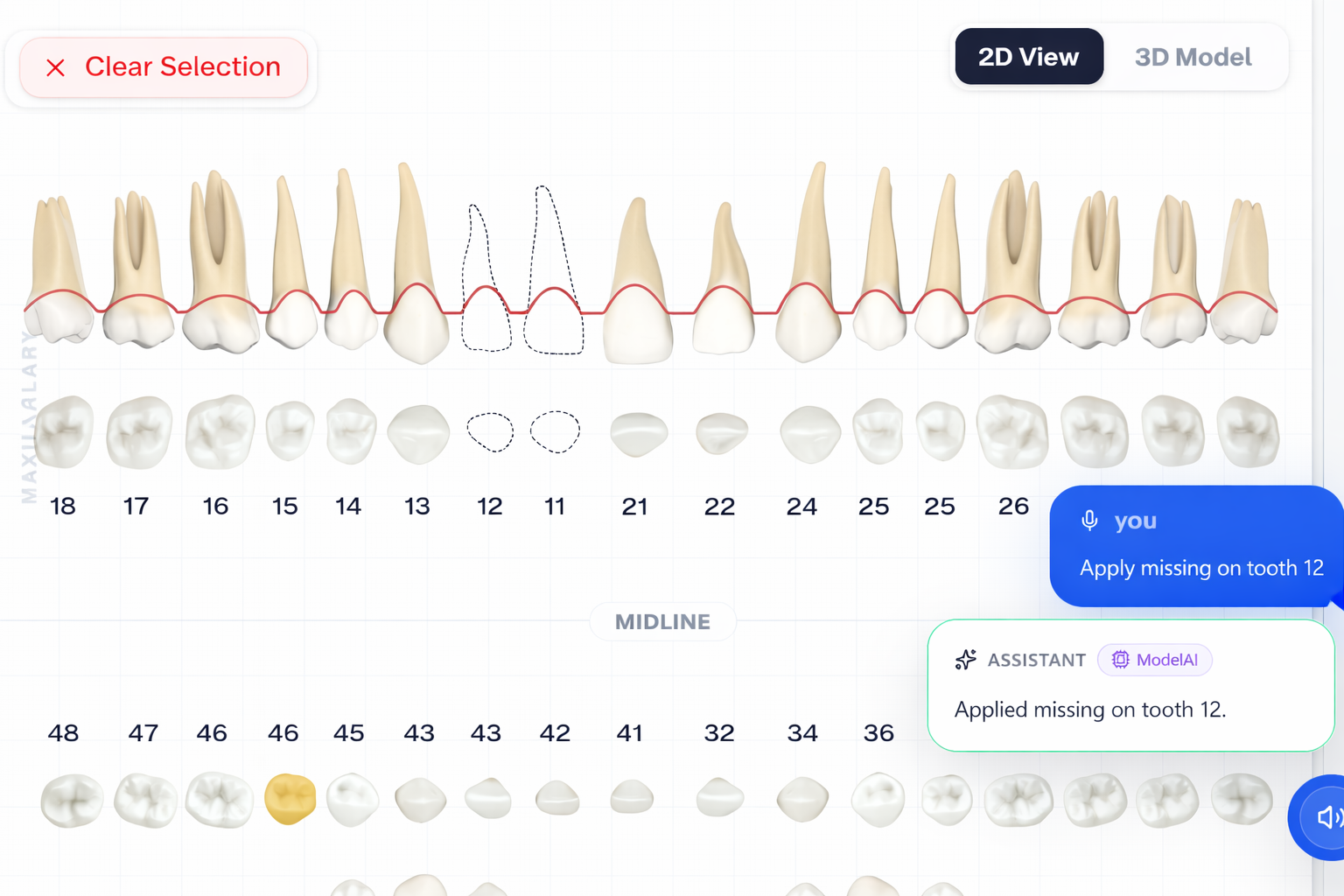 Dental chart view showing an applied missing tooth action inside the Oradentix interface.